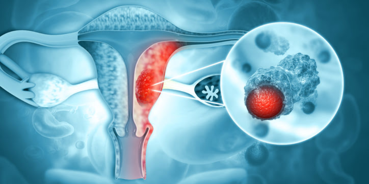 Cáncer de ovario: estos son los síntomas de la silenciosa enfermedad en etapa avanzada
