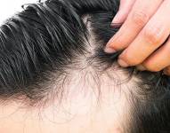 El tratamiento promete atacar las causas de la calvicie y regenerar el cabello en el corto plazo.