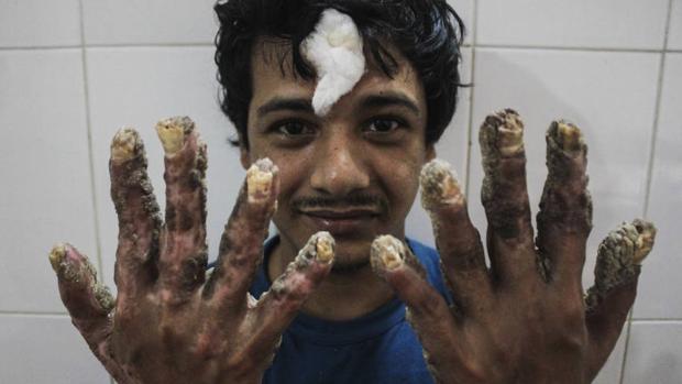 El &#039;hombre árbol&#039; de Bangladesh se siente genial con sus nuevas manos