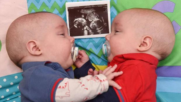 Los gemelos que salvaron su vida dándose la mano antes de nacer