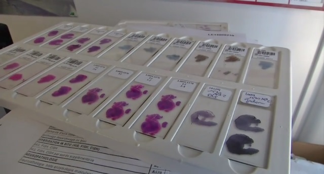 (VIDEO) Logran detectar cáncer pulmonar con un análisis de sangre