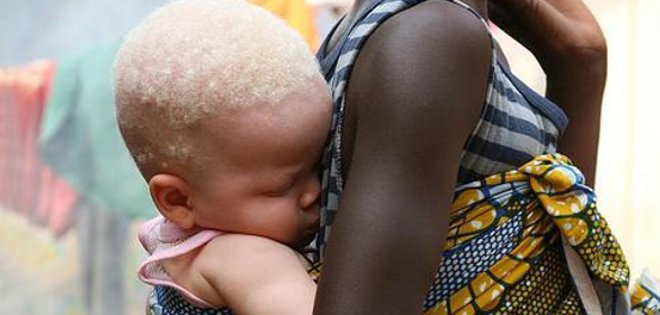 ONU denuncia que resurgen los ataques contra albinos en África