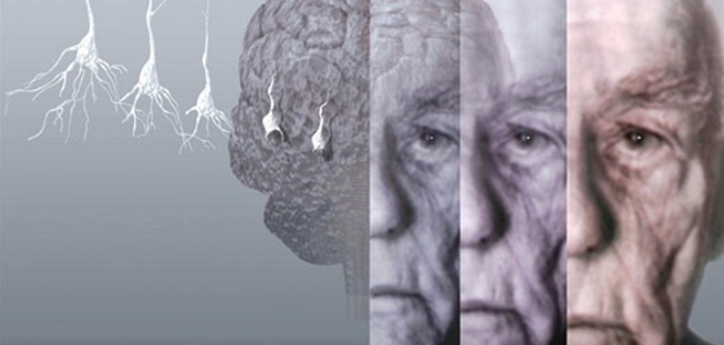 Consumo de ciertos somníferos aumenta el riesgo de alzhéimer