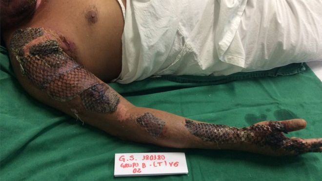 El revolucionario método desarrollado en Brasil para tratar quemaduras graves con piel de tilapia