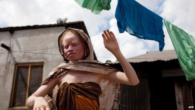 Por qué a los albinos de Tanzania los &quot;matan como a animales&quot;