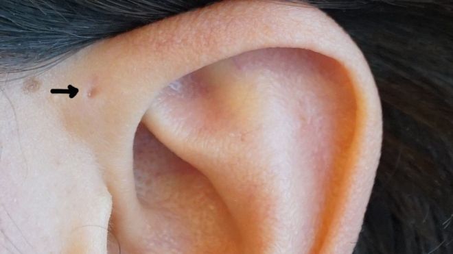 Algunas personas tienen un orificio en la parte superior de la oreja