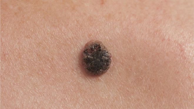Las innovadoras técnicas que frenan la metástasis del melanoma
