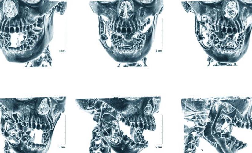Imagen referencial de la radiografía de una mandíbula dislocada.