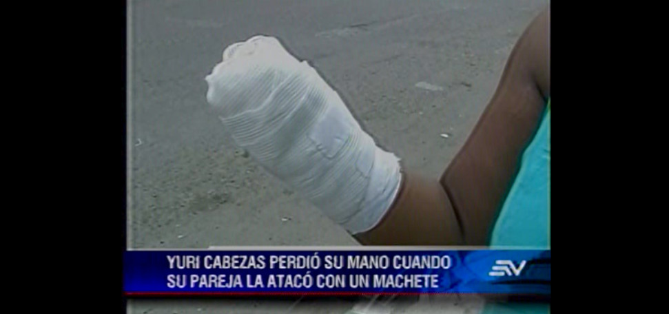Mujer perdió su mano luego de que su conviviente le atacó con un machete