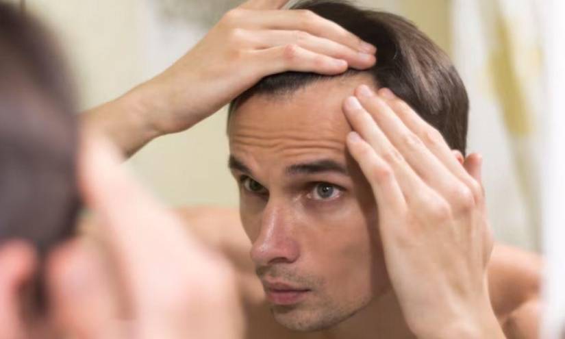 Imagen referencial a la caída de cabello, algo que preocupa a los hombres y mujeres de todo el mundo.