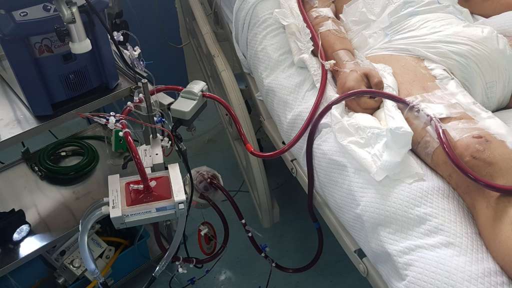 ECMO, la nueva terapia para luchar contra el COVID-19 en Guayaquil