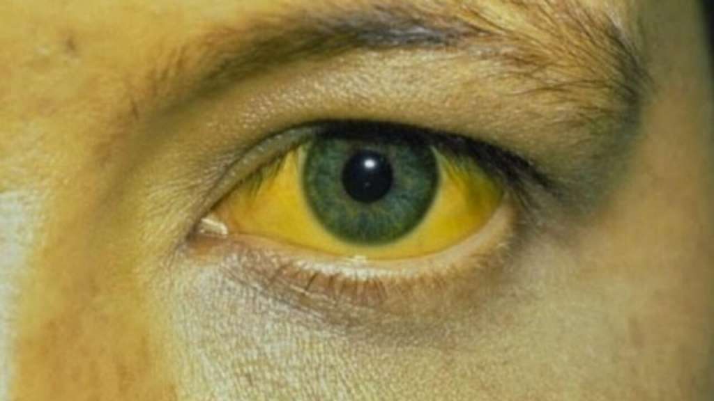 Joven termina con cara amarilla por mascarilla facial