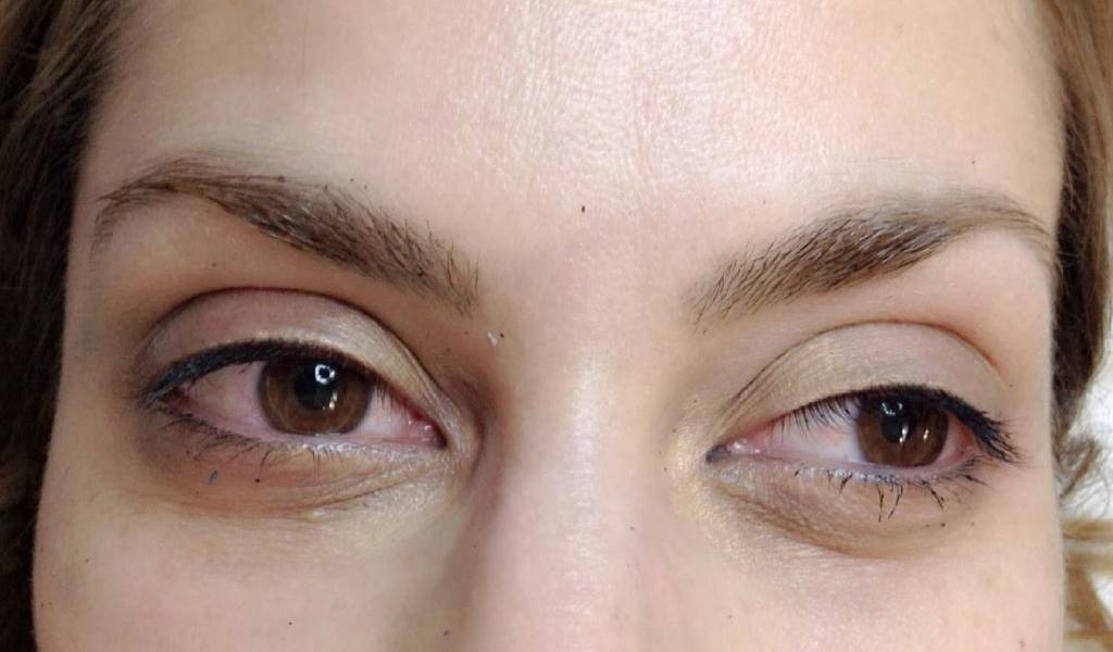 ¿Cómo librarte de las bolsas de los ojos?