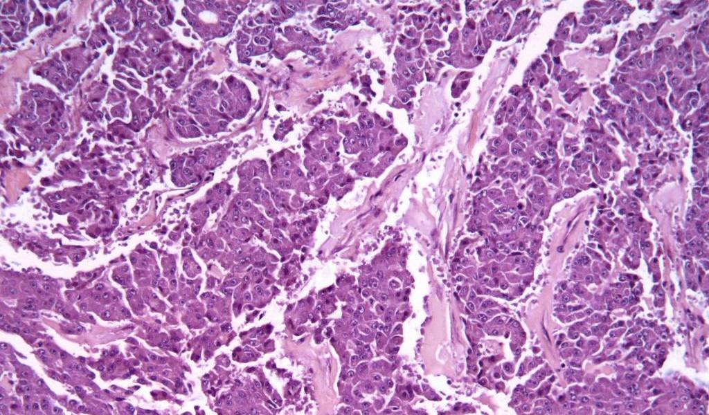 Investigadores españoles hallan una proteína que frena cáncer de páncreas