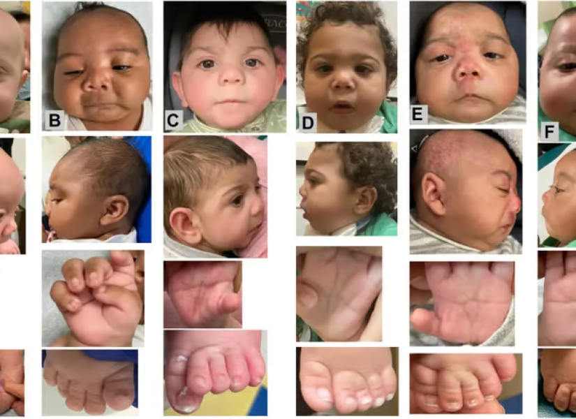 Bebés con posibles afecciones por el fentanilo.