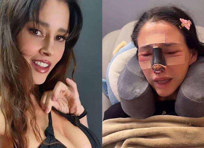 Dorismar, antes y luego de la fallida rinoplastia.