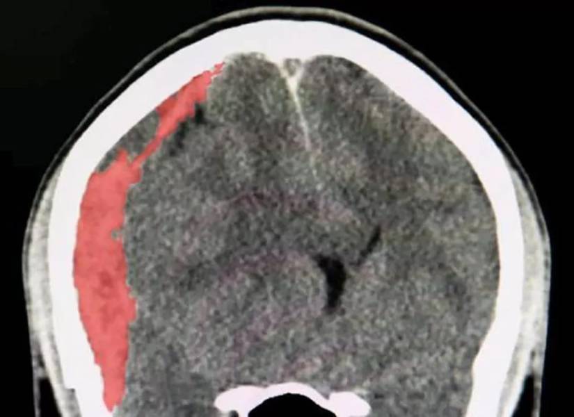 Imagen TAC de un hematoma subdural.