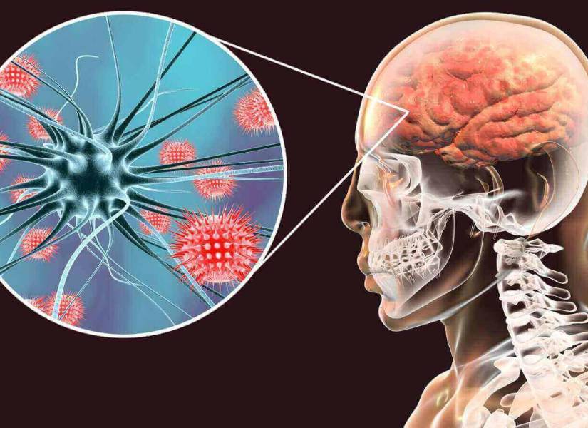 Imagen referencial a la meningitis bacteriana.