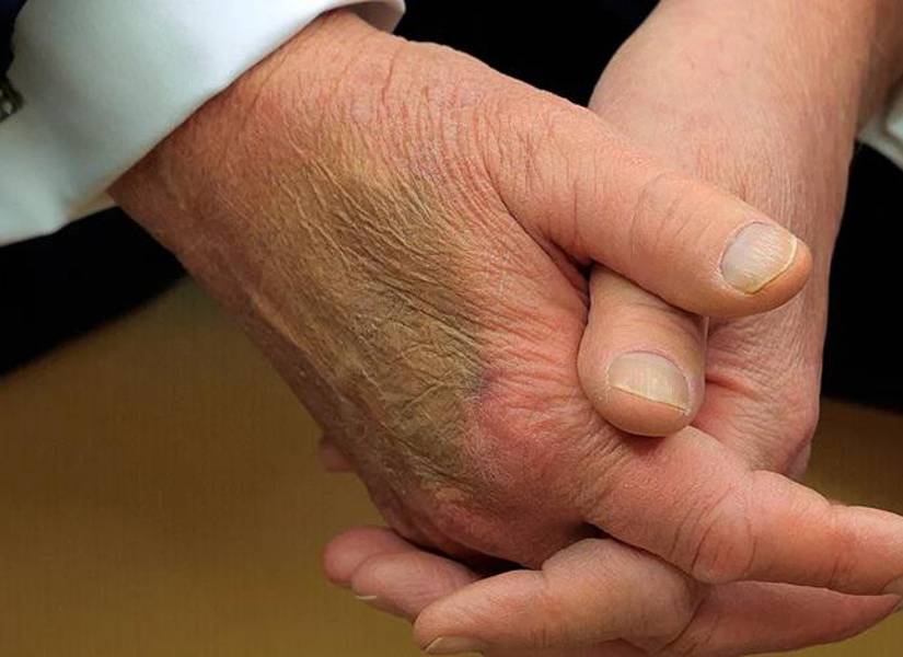 Tump apareció con hematomas en las manos.