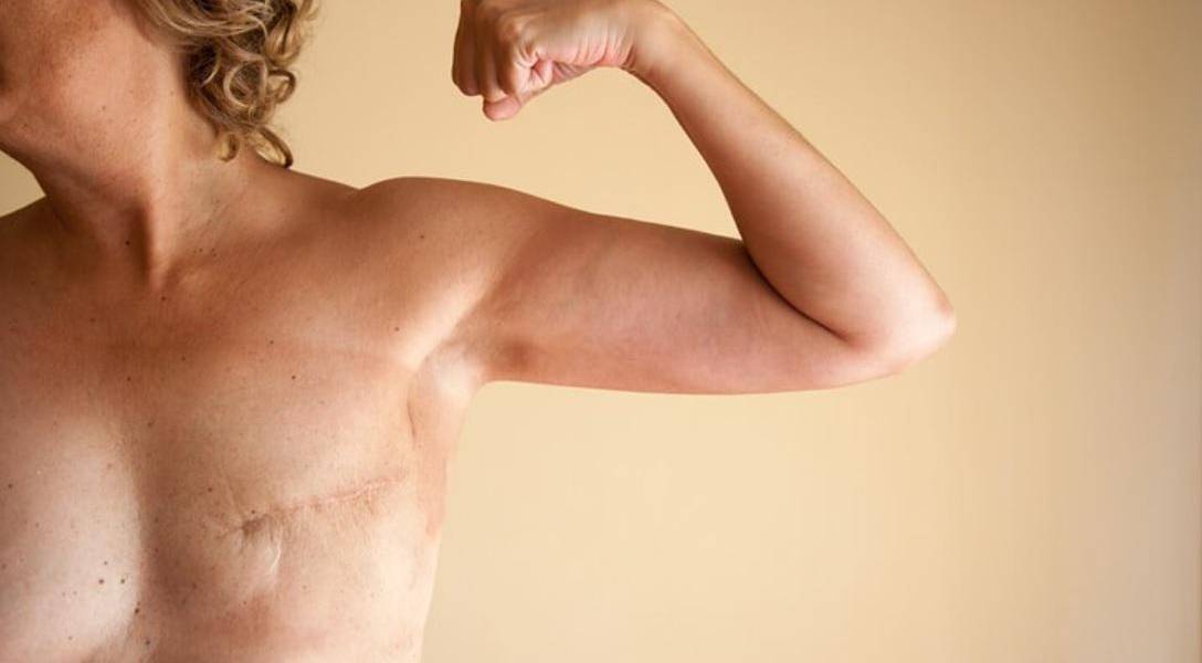 Guayaquil: Cada vez más mujeres que han padecido cáncer de mama, optan por reconstrucción