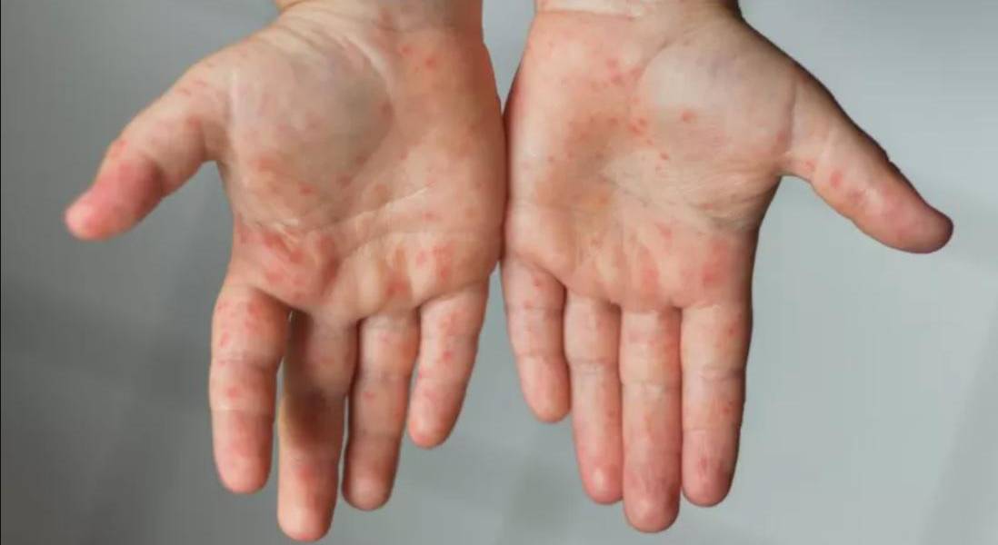 Covid: por qué están comparando a la variante ómicron del coronavirus con el sarampión