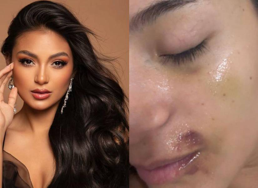 Tatiana Lasso publicó las fotografías en las que se evidencia el maltrato físico.