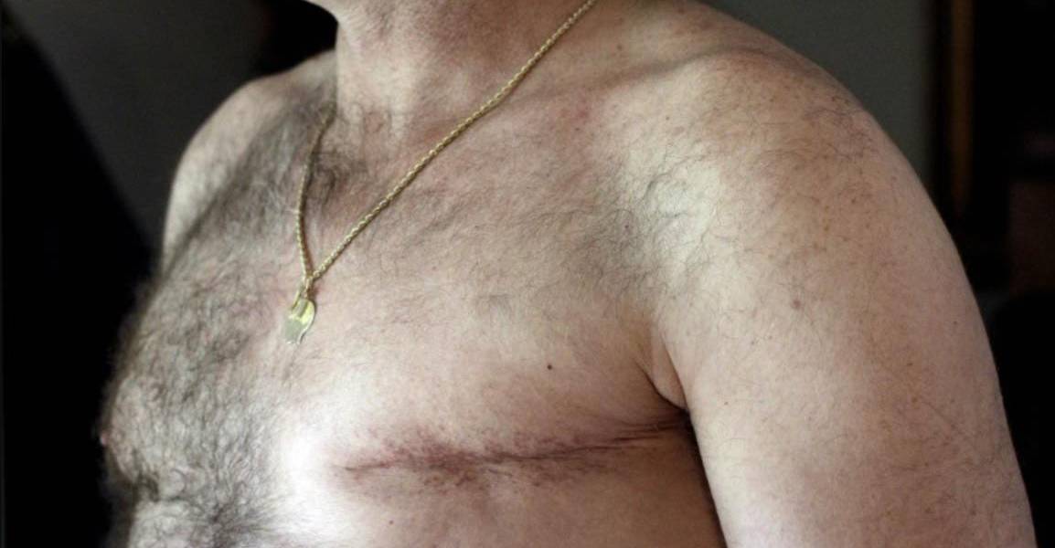 Cáncer de mama en hombres: Estos son los síntomas de un tumor que no se ve