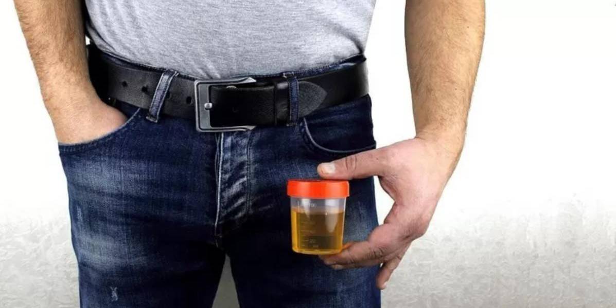 El revolucionario hallazgo que vincula el cáncer de próstata con bacterias en la orina