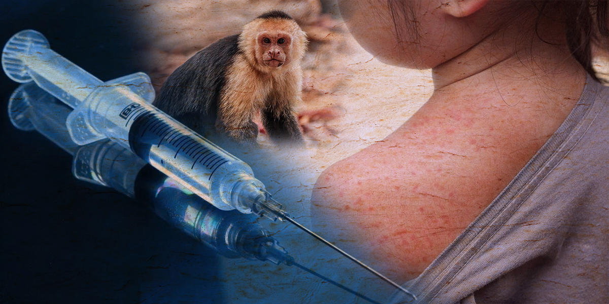 Consejos para evitar contagios de la viruela del mono en niños