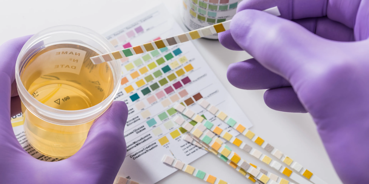 Los cuatro tipos de cáncer que pueden ser detectados con un simple examen de orina