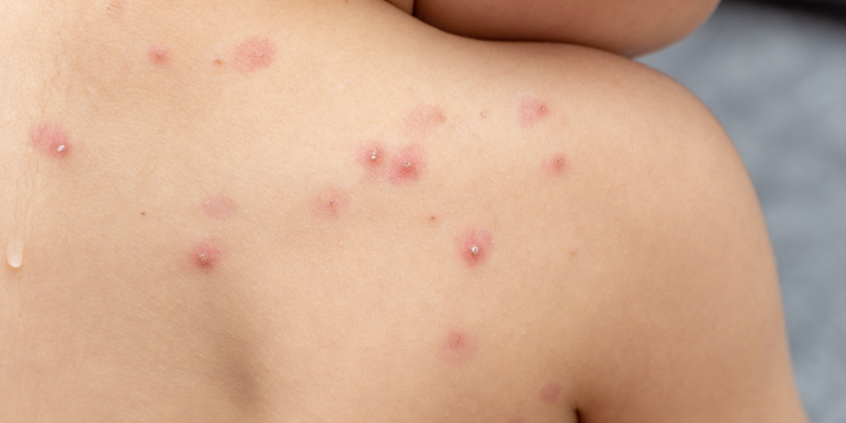 Viruela del mono: Ecuador reporta un nuevo caso sospechoso