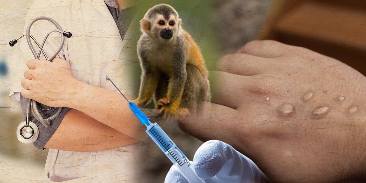 51 casos de viruela del mono hasta el 29 de agosto en Ecuador