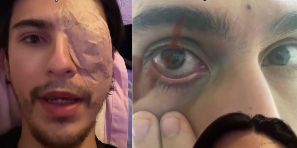 Un joven mexicano pierde su ojo por el mal uso de lentes de contacto y se viraliza al contar su fatídica experiencia en redes