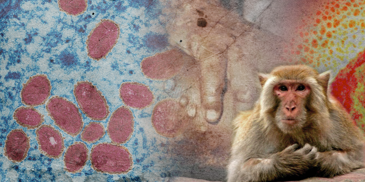 Viruela del mono: Ministerio de Salud confirma el primer caso en Ecuador