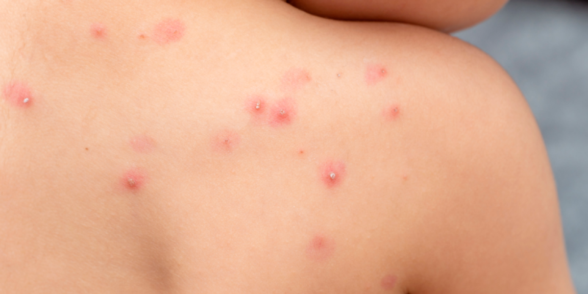 En Ecuador se han reportado cinco casos de la anterior cepa de la viruela del mono