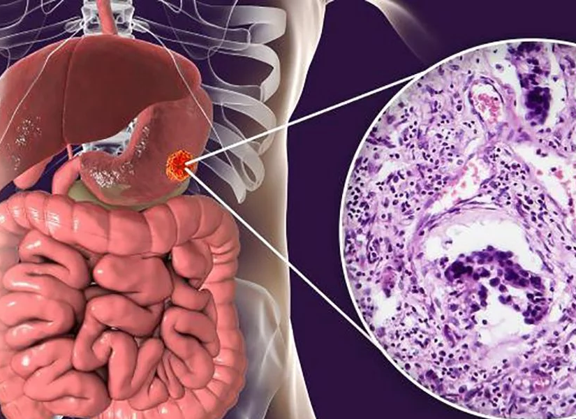 Imagen referencial sobre cómo se ve el cáncer de estómago.