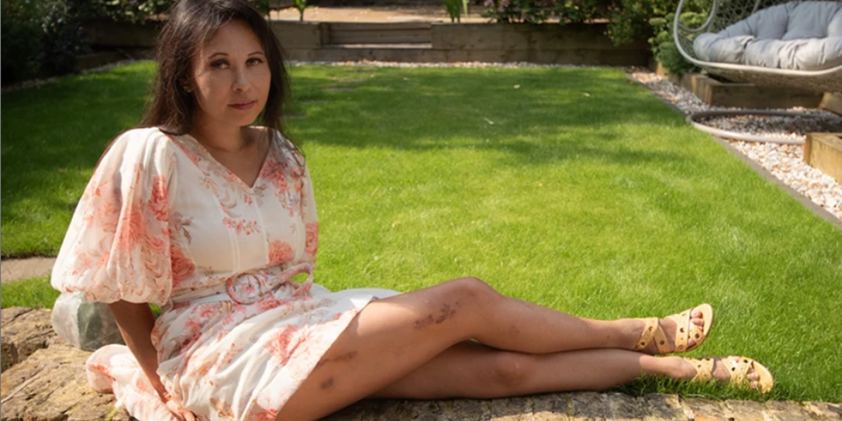 Me operé para alargar mis piernas y todo salió terriblemente mal