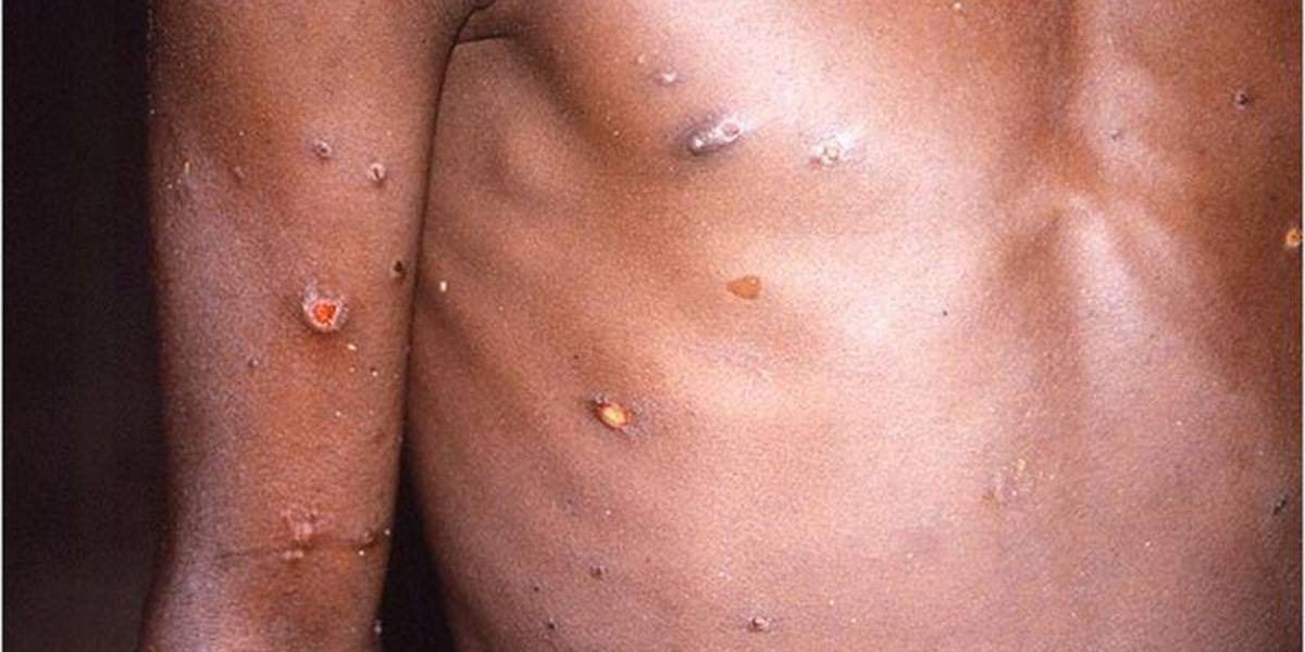 Viruela del mono: ¿cómo se trasmite, cuáles son los síntomas y qué hacer para evitar contagiarte?