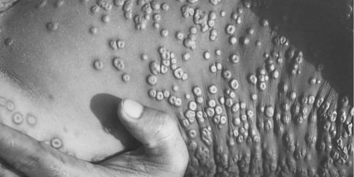 Viruela del mono: en qué se diferencia de la devastadora viruela humana erradicada hace 40 años