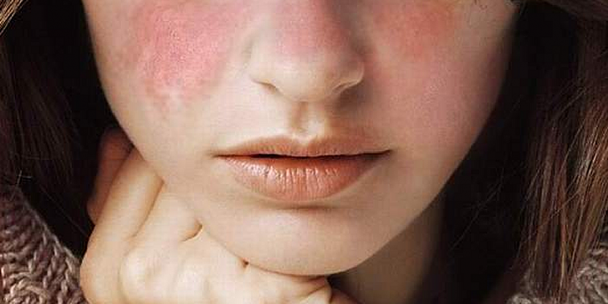 Día Mundial del Lupus: en Ecuador, la mayoría de casos son entre 30 y 34 años