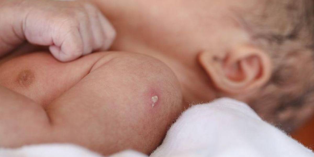 BCG: 100 años de la vacuna más antigua aún en uso