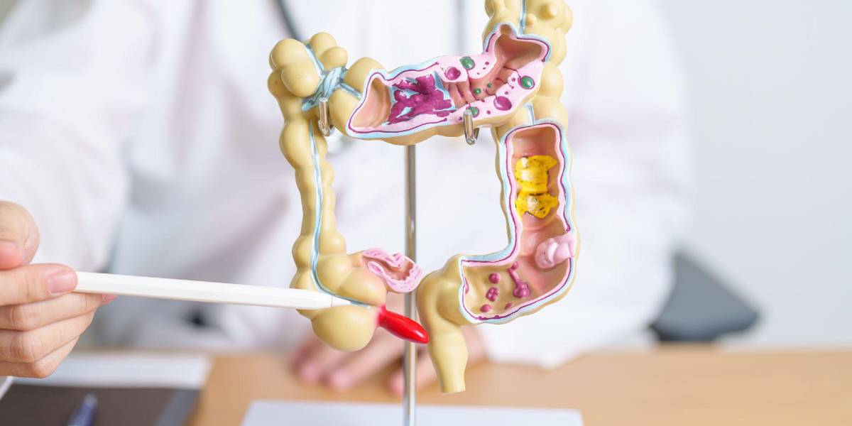 Estas son las enfermedades que se pueden confundir con el cáncer de colon