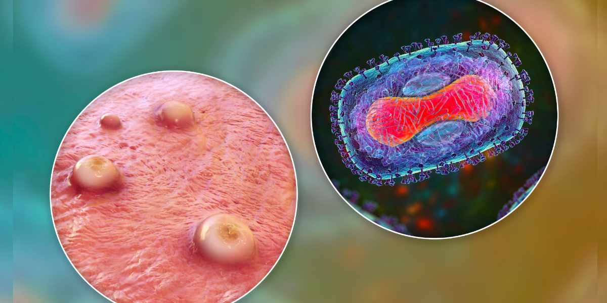 Diferencias entre la viruela del mono, el COVID-19 y la gripe común: ¿Podrían confundirse los síntomas?