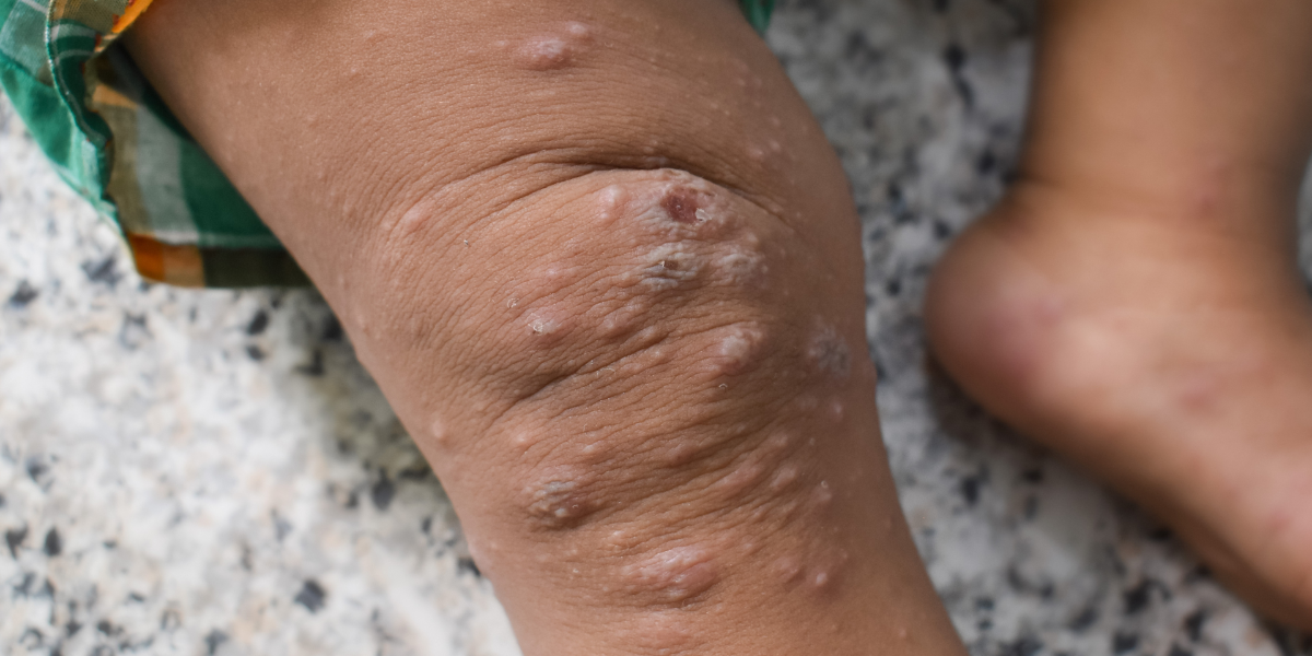 OMS insta a una respuesta global coordinada ante la expansión de Mpox