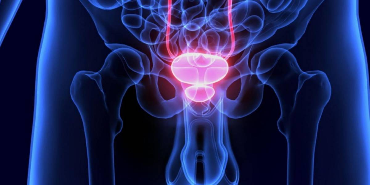 La intervención temprana es clave para detener la progresión del cáncer de próstata