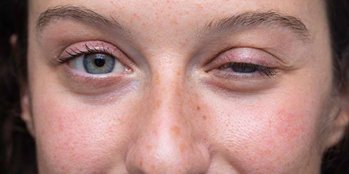 Miastenia Gravis: la enfermedad silenciosa que urge atención y diagnósticos oportunos en América Latina