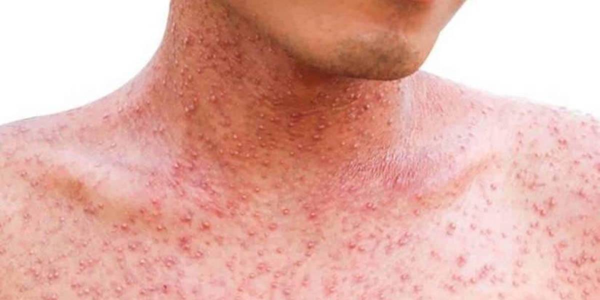 Ministerio de Salud activa el Comité Técnico Nacional de Control de Brote por Sarampión