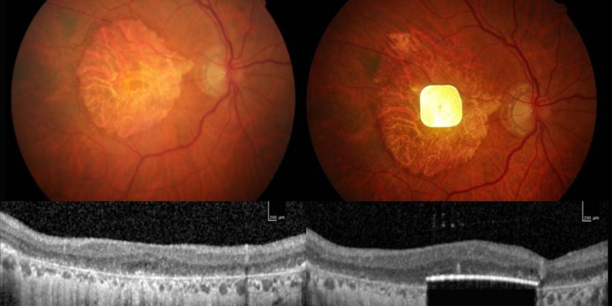 Una prótesis ocular permite leer a personas con ceguera irreversible