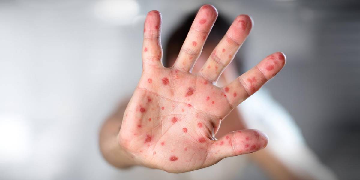 Perú reporta un caso importado de sarampión procedente de Europa