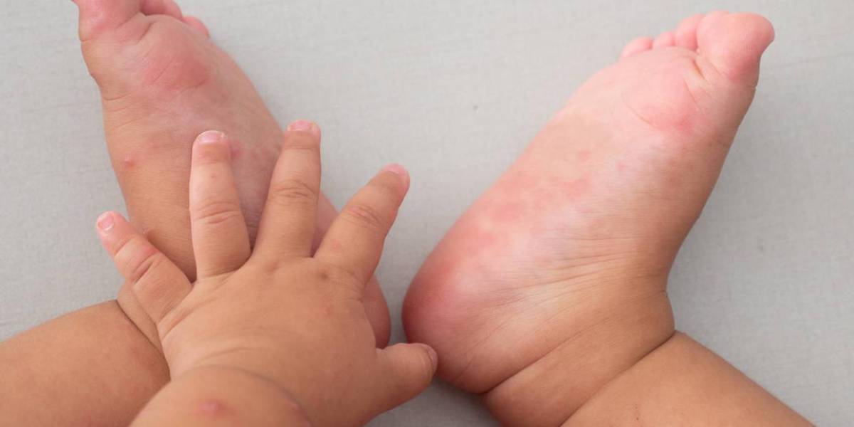 El virus de manos, pies y boca afecta a más niños en Guayaquil ¿Cuáles son los síntomas?